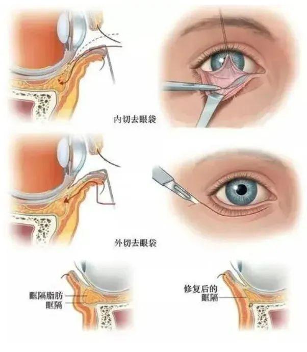 消退减龄十岁！什么方法去眼袋比较有效？j9九游会(中国)网站【名医名科】眼袋(图2)